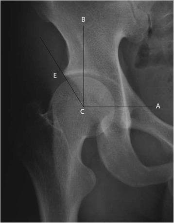This diagnostic image is an anteroposterior (AP) X-ray radiograph of a human hip joint, illustrating the methodology for measuring the center-edge (CE) angle, also known as the Wiberg angle. The anatomical structures shown include the pelvic acetabulum and the proximal femoral head.
Superimposed on the radiograph are three geometric reference lines originating from point 'C', representing the geometric center of the femoral head. Line C-A extends horizontally toward the contralateral hip center as a reference baseline. Line C-B is a vertical line drawn perpendicular to C-A through point C. Line C-E is drawn from the center of the femoral head to the most lateral margin of the acetabular roof (point E). The CE angle is defined as the angle formed between the vertical line C-B and the oblique line C-E.
Clinically, this measurement is essential for orthopedic assessment of acetabular coverage. It is used to diagnose and quantify conditions such as hip dysplasia (reduced CE angle) or pincer-type femoroacetabular impingement (increased CE angle), assisting in surgical planning and postoperative follow-up.