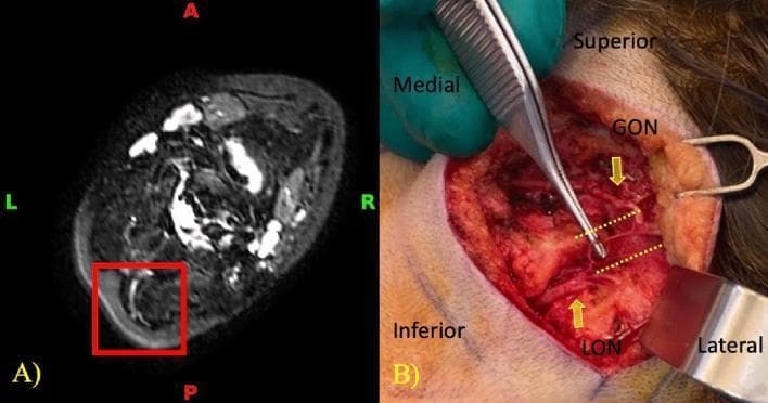 This figure provides a side-by-side comparison of diagnostic imaging and intraoperative findings related to peripheral nerve anatomy in the occipital region. Image A is a transverse NerveView MRI (Magnetic Resonance Neurography) of the neck at the level of the posterior paraspinal muscles. A red box highlights the right greater occipital nerve (GON) and lesser occipital nerve (LON), appearing as hyperintense, tubular structures with a visible anatomical connection. Image B is a corresponding intraoperative clinical photograph during a surgical decompression procedure. Yellow arrows point to the exposed GON and LON within the surgical field, while yellow dotted lines indicate a direct neural communicating branch between the two nerves. The anatomical relationship between these structures is relevant for understanding potential compression points in patients with occipital neuralgia or cervicogenic migraines. The combined images demonstrate the efficacy of high-resolution MRI in identifying fine-scale neural variations that are subsequently confirmed through direct surgical visualization.