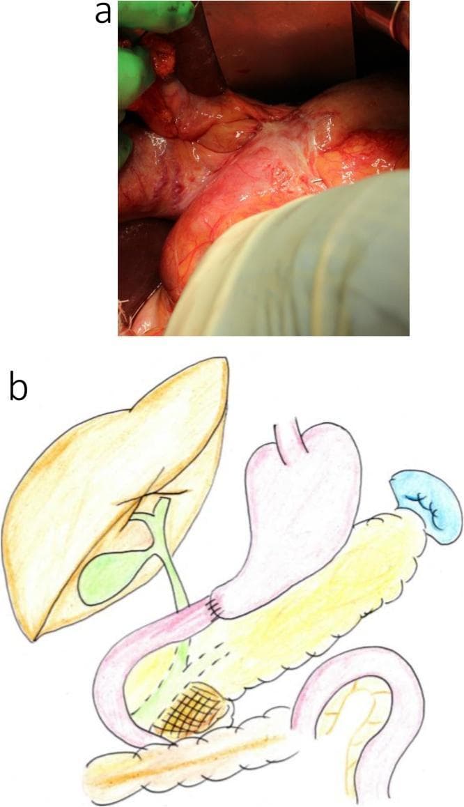 This composite educational material consists of an intraoperative clinical photograph (6a) and a corresponding surgical anatomical diagram (6b) illustrating a complex abdominal surgical revision. Image 6a displays the intraoperative findings in a patient with a prior Billroth II gastric reconstruction, specifically highlighting significant adhesions and fibrotic tissue at the site of the gastrojejunal anastomosis. The surgical field shows the interface between the stomach remnant and the jejunal loop with visible scar tissue and anatomical distortion. Diagram 6b provides a schematic representation of the upper gastrointestinal anatomy, including the liver, biliary tree, stomach, and pancreas. A red line in the diagram demarcates the intended excision range for a subtotal stomach-preserving pancreatoduodenectomy (SSPPD). This boundary indicates the planned resection of the previous gastrojejunal anastomosis and the pancreatic head to address a secondary pathology (IPMN). The visual set demonstrates the challenges of reoperative abdominal surgery, specifically the management of previous anastomotic sites and the planning of complex biliary-pancreatic reconstructions in the setting of prior gastrectomy.