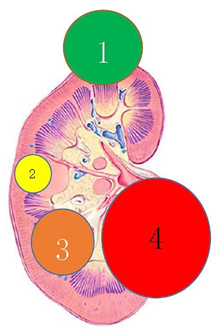 Anatomical diagram of a human kidney in cross-section illustrating a clinical classification system for complex renal cystic lesions based on their spatial location. The diagram uses four color-coded and numbered circles to represent different lesion types: 1) Extra-renal type (green circle), located at the superior pole and protruding significantly beyond the outer renal parenchyma surface; 2) Centrally located type (yellow circle), situated laterally within the renal parenchyma without external protrusion; 3) Renal sinus type (orange circle), located inferiorly within the parenchyma and extending toward the inner collecting system; and 4) Renal hilum type (red circle), shown as the largest lesion located medially at the renal hilum, adjacent to the renal vessels and pelvis. The underlying illustration depicts the renal cortex, medulla, pyramids, calyces, and renal pelvis, providing anatomical context for surgical planning and radiological assessment. This diagram is designed for medical training in urology and radiology to standardize the nomenclature of renal cysts relative to the kidney's structural landmarks.