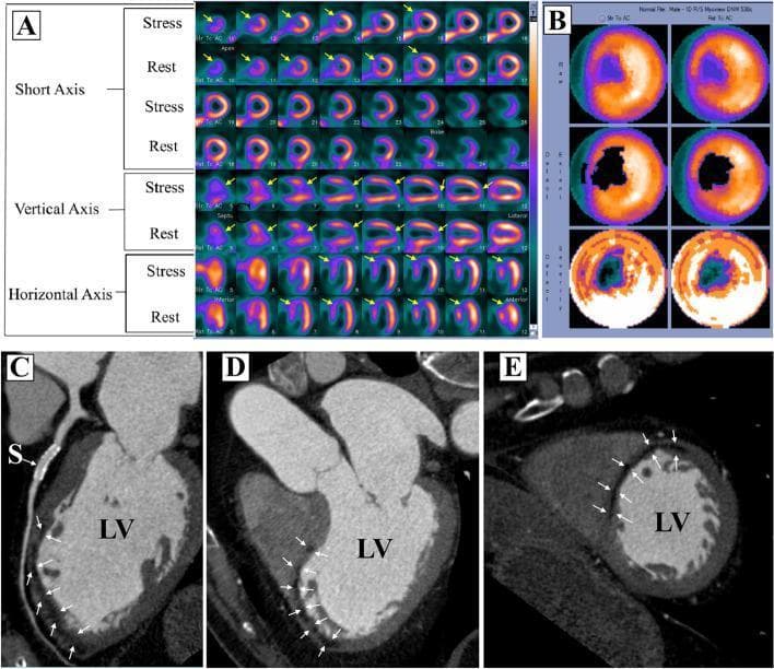 This composite diagnostic image illustrates a multi-modality cardiac assessment for myocardial ischemia and infarction. Panel A displays SPECT Myocardial Perfusion Imaging (MPI) in short-axis, vertical long-axis, and horizontal long-axis views. It shows comparative stress and rest slices where yellow arrows indicate fixed perfusion defects (FPD) in the anterior wall and apex, consistent with prior myocardial infarction. Panel B shows corresponding polar maps (bullseye plots) quantifying the extent and severity of the perfusion defect during stress and rest. Panels C, D, and E are Coronary Computed Tomographic Angiography (CCTA) images. These images demonstrate the anatomical correlation of the SPECT findings, showing a patent coronary stent (labeled 'S') in the left anterior descending artery. White arrows in the CCTA views point to localized sub-endocardial hypo-perfusion and myocardial thinning in the anterior and apical regions of the left ventricle (LV). This multimodal comparison is used in clinical education to differentiate between true myocardial necrosis (scar) and soft tissue attenuation artifacts by correlating functional perfusion deficits with anatomical hypo-enhancement.