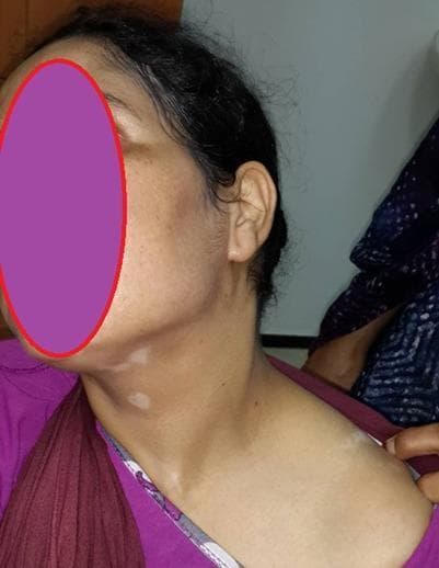 This clinical photograph shows the profile of a 31-year-old female patient with dermatological manifestations often associated with Vogt-Koyanagi-Harada (VKH) syndrome. Visible on the neck and upper clavicular region are several well-circumscribed, depigmented (achromic) patches characteristic of vitiligo. The lesions vary in size, with discrete macules on the neck and more confluent patches near the shoulder. Additionally, the hair at the scalp margin exhibits localized depigmentation, consistent with poliosis (white hair). The clinical significance of these visual findings, when combined with the patient's history of panuveitis and auditory symptoms, supports the diagnosis of an autoimmune multi-system disorder affecting melanocyte-containing tissues. This image serves as a clinical example of the integumentary signs in systemic autoimmune disease, targeted at medical students and dermatology residents specializing in pigmentary disorders and their extra-cutaneous associations.