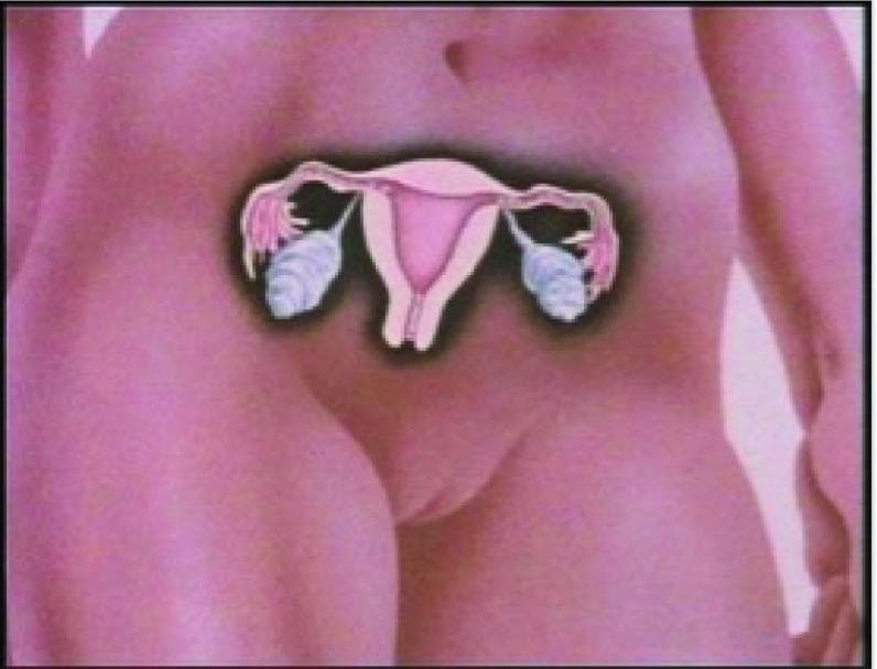 This medical illustration features an anatomical diagram of the female reproductive system superimposed onto a photographic frontal view of a female torso. The diagram focuses on the pelvic anatomy, highlighting the uterus, fallopian tubes, and ovaries in a simplified, educational style. The uterus is centrally positioned and depicted with a clear endometrial cavity and cervical canal. Extending laterally from the superior portion of the uterus (the fundus) are the fallopian tubes, which exhibit a characteristic tortuous morphology ending in finger-like fimbriae. Associated with the distal ends of the tubes are the ovaries, rendered with a textured, lobulated surface to represent follicular development. The graphic uses contrasting colors—pink for the uterine and tubal structures and a light blue-grey for the ovaries—to enhance visual differentiation. This content type serves as a primary educational tool for explaining reproductive health, infertility, and the anatomical context of procedures such as in vitro fertilization (IVF).