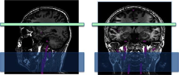 Diagnostic neuroimaging diagram illustrating the setup for Pulsed Arterial Spin Labeling (PASL). The image contains two panels: a sagittal view (left) and a coronal view (right) of the human head and neck, presented as T1-weighted MRI scans. Superimposed on these scans is a large blue rectangular block representing the labeling slice prescription (inversion slab), positioned over the neck region to capture inflowing blood. Within this blue slab, the major feeding arteries (carotid and vertebral arteries) are highlighted in purple, demonstrating the volume where water molecules in the blood are magnetically labeled. A light green horizontal bar is positioned higher across the cerebral cortex, indicating the imaging plane or region where tissue perfusion signal will be measured after a post-labeling delay. Key anatomical landmarks visible include the cervical spine, brainstem, cerebellum, and the base of the skull, showing the spatial relationship between the labeling site in the neck and the target imaging site in the brain. This visual serves as an educational guide for technical MRI protocol positioning in perfusion imaging.