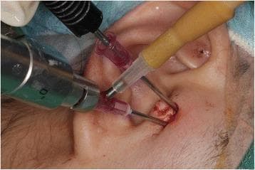 A clinical photograph capturing a minimally invasive surgical procedure on the temporomandibular joint (TMJ). The image demonstrates a dual-portal technique with instruments inserted anterior to the external auditory canal. One portal utilizes a specialized needle system (Chung’s needle) through which an ultra-thin rigid arthroscope is inserted to provide visualization of the joint space. A second portal contains a radiofrequency (RF) surgery tip, used for tissue ablation or coagulation of the retrodiscal tissue. The skin at the insertion sites shows localized erythema and minor serosanguinous drainage, typical of acute intraoperative puncture sites. The anatomical orientation focuses on the preauricular region, illustrating the technical setup for arthroscopic diagnosis and treatment of TMJ disorders such as habitual dislocation or internal derangement. This image serves as a clinical example of arthrocentesis and operative arthroscopy in maxillofacial surgery.