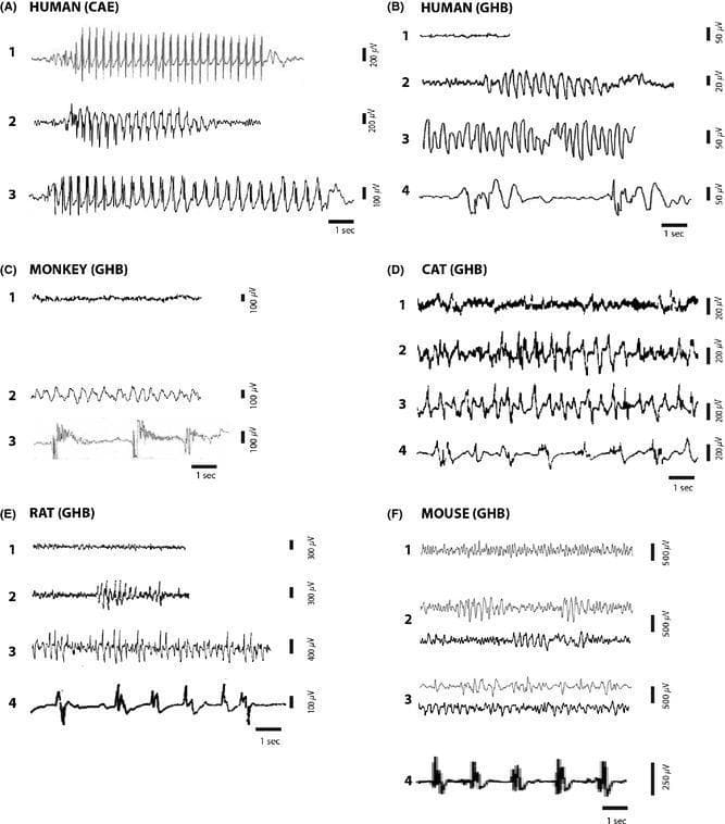This comparative EEG figure illustrates the neurophysiological signatures of absence seizures (ASs) and gamma-hydroxybutyrate (GHB/GBL)-induced states across humans and animal models (monkey, cat, rat, mouse). Panel A displays scalp EEG from Childhood Absence Epilepsy (CAE) patients, highlighting hallmark 3–4 Hz spike-and-wave discharges (SWDs) emerging abruptly from a desynchronized background. Panels B–F demonstrate dose-dependent progression following GHB/GBL administration: 1) initial desynchronized activity; 2) intermittent slow/delta waves or SWDs (species-dependent, e.g., 2–3 Hz in humans/monkeys, 5–6 Hz in rats); 3) continuous hypersynchronous activity; and 4) a burst-suppression pattern at high doses, characterized by high-amplitude bursts of slow waves interrupting periods of electrical silence. Key educational focus includes the morphological variation of the spike component across species and the shift from intermittent paroxysms to continuous synchronization and deep anesthesia. This serves as a clinical and experimental reference for epilepsy research and pharmacological modeling of impairment of consciousness.
