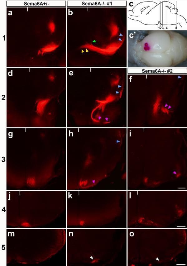 This composite of fluorescent micrographs illustrates axonal guidance defects in the corticospinal tract (CST) using DiI tracing in mouse models, specifically comparing Sema6A+/- (control-like) and Sema6A-/- (mutant) phenotypes. The images represent coronal cross-sections at five distinct neuroanatomical levels: the mid-hindbrain boundary (MHB) through the caudal medulla. In control mice (left column), CST axons follow a stereotyped medial and then ventral path toward the midline. In Sema6A-/- mutants (middle and right columns), multiple axonal routing abnormalities are visible: axons turning dorsally at the cerebral peduncle (blue arrowheads), aberrant midline crossing (yellow arrowheads), or splitting into disorganized bundles in the pons (magenta arrowheads). At the level of the inferior olive and caudal medulla (bottom rows), control axons maintain a tight midline position prior to decussation. Conversely, mutant axons often project laterally and proceed ipsilaterally (white arrowheads), failing to decussate. This neurodevelopmental study demonstrates the critical role of Semaphorin 6A signaling in hemming axons near the midline to ensure proper pyramidal decussation, with implications for understanding CST malformations like those seen in Joubert syndrome.