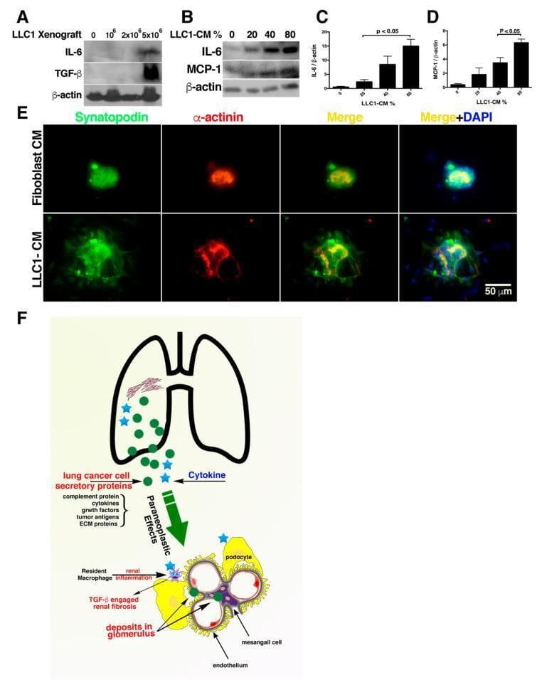 Educational medical composite depicting the paraneoplastic effects of lung cancer on renal pathophysiology. (A-B) Western blot analyses showing dose-dependent increases in inflammatory markers (IL-6, TGF-̢, and MCP-1) in both mouse kidney tissues and NRK-52E renal cells following exposure to LLC1 (Lewis Lung Carcinoma) xenografts or conditioned medium (LLC1-CM). (C-D) Bar graphs quantifying the significant (p < 0.05) increase in IL-6 and MCP-1 relative to ̢-actin loading controls. (E) Multi-channel immunofluorescence images of cultured glomeruli. Top row (Fibroblast-CM control) shows tightly clustered podocytes with high expression of Synaptopodin (green) and ̡-actinin (red). Bottom row (LLC1-CM) demonstrates loss of glomerular integrity, characterized by dispersed podocyte arrangement and disrupted microfilament bundling. (F) Pathophysiology diagram illustrating the proposed mechanism: lung cancer secretory proteins (cytokines, complement, growth factors) trigger paraneoplastic effects including resident macrophage activation, TGF-̢-engaged renal fibrosis, and glomerular deposits leading to glomerulopathy. This resource illustrates the remote systemic impact of tumor secretomes on kidney function.