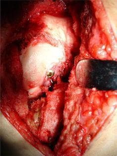 This clinical photograph captures an intraoperative view of an open reduction and internal fixation (ORIF) of a Hoffa fracture (coronal plane femoral condyle fracture). The surgical field shows the distal femur exposed through an arthrotomy, with the knee in a flexed position to visualize the articular surface. A primary focus is the femoral intercondylar notch, where a metallic cancellous screw has been inserted as part of a novel fixation technique. The screw head is visible at the entry point within the notch, directed toward the fractured condylar fragment to provide stable compression. A metallic bone repositioning clamp is visible on the right side of the frame, maintaining the reduction of the fracture during hardware placement. Surrounding structures include the articular cartilage of the femoral condyles, exposed cancellous bone, and soft tissue margins. This image serves as a clinical example of orthopedic trauma surgery, specifically demonstrating the anatomical positioning for intercondylar screw fixation in complex intra-articular knee fractures.
