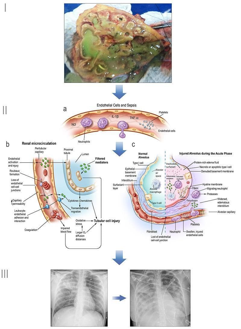Educational infographic illustrating the pathogenesis of sepsis and multi-organ dysfunction. Section I shows a clinical photograph of a necrotic kidney (pyelonephritis). Section II contains three pathophysiology diagrams: (a) General endothelial changes in sepsis, depicting neutrophil extravasation, platelet activation, and release of inflammatory mediators like TNF-α, IL-1β, and NO; (b) Renal microcirculation injury, highlighting peritubular capillary changes (rouleaux formation, leukocyte adhesion, increased permeability) and subsequent tubular cell injury via oxidative stress and impaired blood flow; (c) Alveolar-capillary comparative diagram, contrasting a normal alveolus with one in the acute phase of ARDS, showing hyaline membrane formation, protein-rich edema, and Type I cell necrosis. Section III features diagnostic chest X-rays demonstrating progressive bilateral opacities consistent with acute respiratory distress syndrome. This visual summary correlates clinical findings, diagnostic imaging (radiography), and microscopic pathophysiology to explain systemic sepsis-induced organ failure.