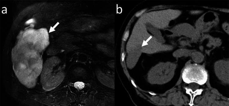 This diagnostic comparison demonstrates the longitudinal progression and shrinkage of a giant hepatic hemangioma in the right lobe of the liver. Image (a) is an axial fat-saturated T2-weighted magnetic resonance image (MRI) representing the baseline study. It reveals a large, hyperintense, lobulated mass (arrow) measuring 106 mm in diameter with a heterogeneous internal signal characteristic of cavernous hemangiomas. Image (b) shows the same patient 188 months later using axial unenhanced computed tomography (CT). The follow-up scan indicates significant involution of the lesion (arrow), now measuring 46 mm in diameter. On CT, the hemangioma appears as a well-defined, hypoattenuating region compared to the surrounding liver parenchyma. This case illustrates the natural history and potential for spontaneous regression in benign hepatic vascular tumors. Relevant landmarks include the vertebrae and renal silhouettes, providing anatomical context for the lesion's position within the right hepatic lobe. The content is suitable for radiology education regarding liver tumor monitoring and differential diagnosis.