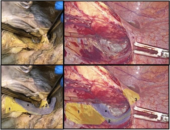 This composite image provides a side-by-side comparison of autonomic nerve structures in the human pelvis during cadaveric dissection (left) and laparoscopic surgery (right). The primary educational focus is the identification of key neural landmarks relevant to Total Mesorectal Excision (TME) to prevent post-operative dysfunction. Marked structures include: (1) the superior hypogastric plexus, appearing as yellowish connective tissue at the level of the promontory; (2) the hypogastric nerves, shaded in a dark bluish-grey, descending into the pelvis; and (3) the rectal nerves arising from the inferior hypogastric plexus, which are seen extending toward the posterolateral wall of the rectum. An asterisk (*) denotes the endopelvic or ureterohypogastric fascia, a critical surgical plane used to protect the hypogastric nerves during posterior and lateral dissection. The comparison demonstrates how these anatomical features transition from gross cadaveric tissue to their appearance under laparoscopic magnification and insufflation, emphasizing the importance of nerve-sparing techniques in colorectal surgery.