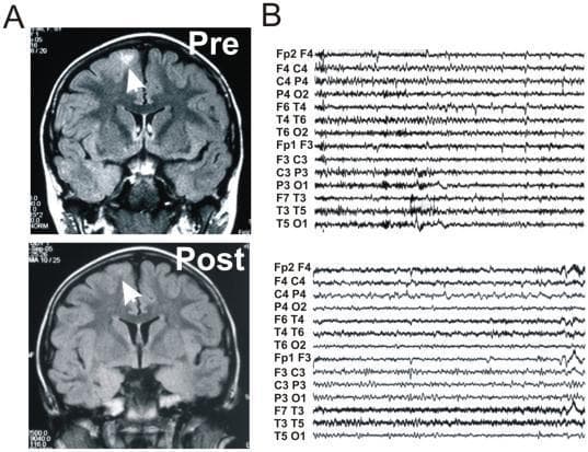 This composite educational graphic illustrates radiologic and electrophysiologic markers of treatment response in a patient with epilepsy. Panel A displays two coronal Fluid-Attenuated Inversion Recovery (FLAIR) MRI scans of the brain. The 'Pre' treatment image shows a focal area of cortical and subcortical hyperintensity in the superior frontal gyrus (indicated by a white arrow), suggesting edema or blood-brain barrier dysfunction. The 'Post' treatment image demonstrates a significant reduction of this hyperintensity following corticosteroid therapy. Panel B presents corresponding EEG traces. The 'Pre' traces show high-amplitude, high-frequency polyspike and wave discharges across multiple channels (e.g., Fp2-F4, F3-C3), characteristic of ictal or interictal epileptiform activity. The 'Post' EEG traces exhibit a marked decrease in the frequency and amplitude of these discharges, returning toward a more organized background rhythm. This comparison highlights the correlation between reduced neuroinflammation (visualized on MRI) and clinical seizure control (visualized on EEG).