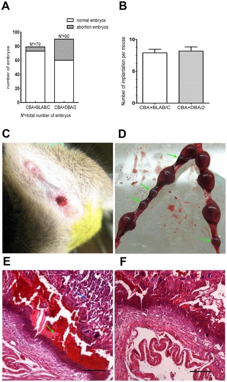 This composite image illustrates clinical and pathological findings in a murine model of spontaneous abortion, used as a surrogate for studying human miscarriage. Panel A displays a bar graph comparing embryo outcomes between two groups, showing a significantly higher abortion rate in the CBA!!!DBA/2 group. Panel B confirms comparable implantation rates between experimental and control groups. Panel C is a clinical photograph of a mouse exhibiting vaginal bleeding, a sign of threatened or inevitable abortion. Panel D shows a gross anatomical view of uterine horns; green arrows highlight abortion-prone embryos, which appear as dark, reddish-brown, dysplastic bulges with no clear distinction between fetus and placenta. Panels E and F provide light microscopy images (H&E stain) of uterine cross-sections. Panel E demonstrates significant pathology at an abortion-prone site, including extensive hemorrhage (green arrows) and necrotic tissue (blue arrow). In contrast, Panel F shows healthy uterine tissue with organized architecture and minimal vascular disruption. The educational focus is on the pathophysiology of pregnancy loss, specifically ischemia, hemorrhage, and necrosis at the implantation site.
