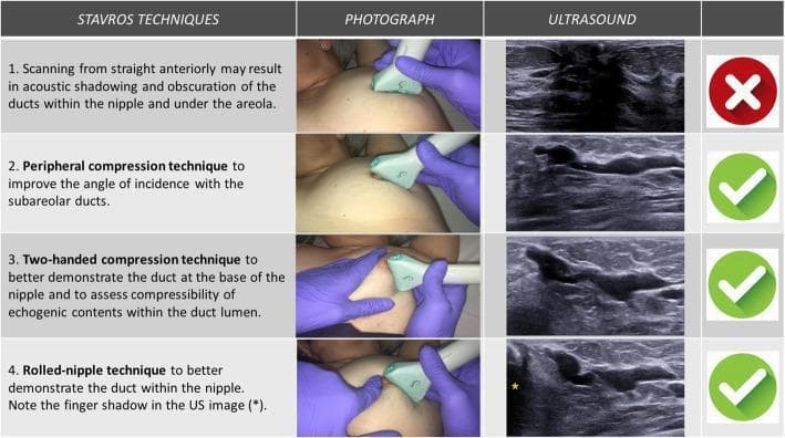 A comparison chart illustrating four Stavros ultrasound (US) techniques for evaluating the breast nipple-areolar complex and subareolar ducts. The chart is organized into four columns: technique description, clinical photograph of probe positioning, resulting ultrasound image, and a diagnostic value indicator (red 'X' or green checkmark).
1. Straight anterior scanning: Shows a probe placed vertically on the nipple, resulting in an ultrasound image with significant posterior acoustic shadowing that obscures the ducts.
2. Peripheral compression technique: Demonstrates the probe angled from the periphery toward the nipple. The US image shows improved visualization of longitudinal, hypoechoic subareolar ducts due to a better angle of incidence.
3. Two-handed compression technique: A photograph shows one gloved hand stabilizing/compressing the tissue while the probe is applied. This evaluates duct compressibility and echogenic lumen contents.
4. Rolled-nipple technique: Shows the nipple being manipulated/rolled by a finger while scanning. The US image reveals the duct within the nipple, marked by a characteristic finger shadow (yellow asterisk).
This educational visual is designed for radiology training to optimize the detection of intraductal pathologies like papillomas or ectasia.