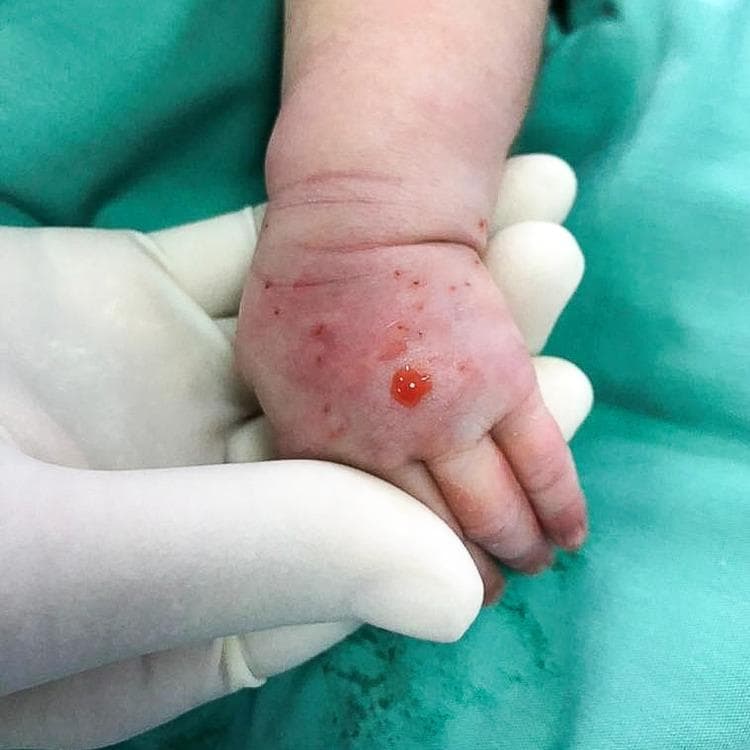 This clinical photograph displays the dorsum of the left hand of a neonate, illustrating an intravenous (IV) extravasation injury. The anatomical region from the metacarpophalangeal joints to the distal forearm exhibits significant diffuse erythema and non-pitting edema. Multiple small, punctate red marks are visible across the dorsal surface, consistent with repeated venipuncture attempts. A central, larger puncture site shows an accumulation of bright red serosanguinous fluid, suggesting recent cannulation or saline flush-out therapy. Despite the dorsal swelling, the visible fingers appear pink and well-perfused, indicating preserved distal circulation. This image serves as an educational example of neonatal skin injury following IV infiltration of a vesicant or irritant solution, highlighting the clinical signs of early-stage extravasation including inflammatory changes and tissue distention.