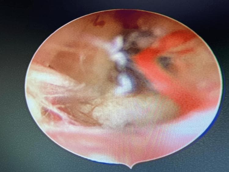This clinical diagnostic image is a hysteroscopic view of the uterine cavity during a surgical adhesiolysis procedure. The image depicts intrauterine adhesions (Asherman syndrome) characterized by thick, whitish, fibrous bands and opaque web-like structures bridging the uterine walls. The background shows the healthy pinkish-red mucosal lining of the endometrium and visible branching blood vessels. A dark gray, thin, 5-Fr surgical scissor is positioned within the frame, actively engaging with the dense adhesions to restore the normal volume and architecture of the uterine cavity. The educational focus of this image is the visual identification of intrauterine synechiae and the procedural technique of hysteroscopic lysis in a patient with infertility or recurrent pregnancy loss.