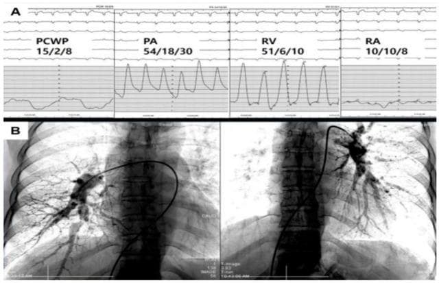 This composite educational image illustrates diagnostic modalities for Chronic Thromboembolic Pulmonary Hypertension (CTEPH). Part A displays Right Heart Catheterization (RHC) hemodynamic waveforms and pressure readings. The pulmonary artery (PA) pressure (54/18/30 mmHg) and right ventricular (RV) pressure (51/6/10 mmHg) show significant systolic elevation, while the pulmonary capillary wedge pressure (PCWP 15/2/8 mmHg) remains within the normal range, confirming a precapillary pulmonary hypertension profile. Part B presents Digital Subtraction Angiography (DSA) of the bilateral pulmonary vasculature. A diagnostic catheter is seen traversing the right heart into the pulmonary arteries. The angiography reveals characteristic CTEPH findings, including irregular arterial branching, segmental stenoses, and 'pruned' distal vasculature, particularly evident on the left side. These visual features signify organized thrombi and microvasculopathy. This material is designed for advanced medical education in cardiology and pulmonology to demonstrate the integration of invasive hemodynamics and vascular imaging in the confirmatory diagnosis of Group 4 pulmonary hypertension.