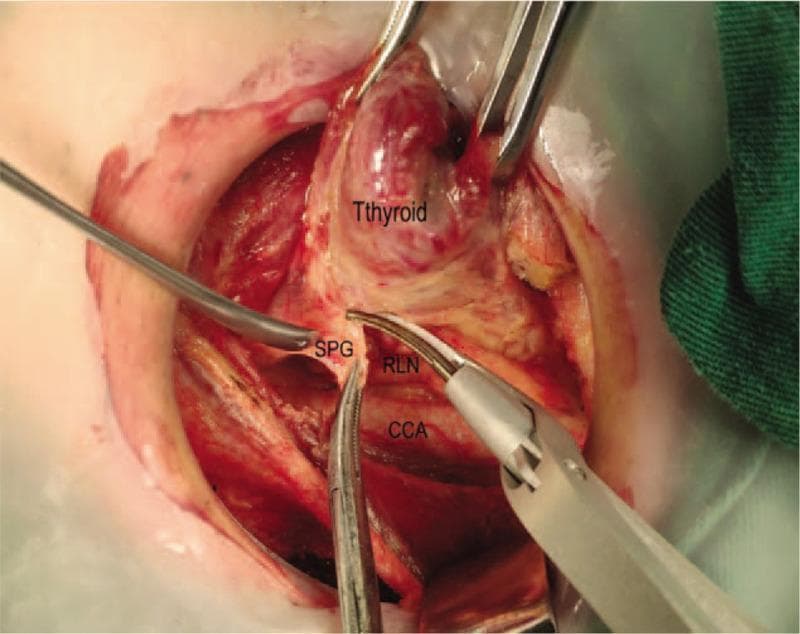 This clinical photograph shows an intraoperative view of a thyroidectomy, specifically highlighting the dissection and preservation of critical neurovascular and glandular structures. The thyroid gland is superiorly retracted. Below it, the Superior Parathyroid Gland (SPG) is identified and carefully protected. The Recurrent Laryngeal Nerve (RLN) is clearly visualized running parallel and superficial to the Common Carotid Artery (CCA). Surgical instrumentation, including dissecting forceps and a specialized thermal or ultrasonic cutting device, is being used to perform precise dissection in the tracheoesophageal groove. The image demonstrates the 'upward separation' technique aimed at isolating the thyroid lobe while maintaining the integrity of the RLN and vascular supply to the parathyroid glands. This educational visual emphasizes surgical anatomy and safety protocols for residents and surgeons performing endocrine neck surgery.