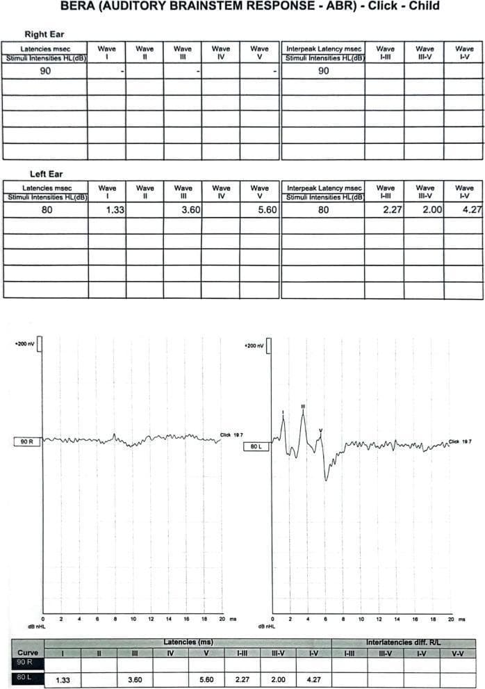 This diagnostic report presents an Auditory Brainstem Response (ABR/BERA) test for a pediatric patient using click stimuli. The image contains both numerical data tables and neurophysiological waveforms for the right and left ears. The 'Right Ear' (90 R) waveform is significantly abnormal, appearing flat and without identifiable peaks (Waves I-V), indicating an absent response to auditory stimuli at 90 dB nHL. In contrast, the 'Left Ear' (80 L) display shows a normal neurophysiological response with clearly defined and labeled waveforms for Waves I (1.33 ms), III (3.60 ms), and V (5.60 ms). Accompanying tables provide detailed latency and inter-latency measurements for the left ear, including I-III (2.27 ms), III-V (2.00 ms), and I-V (4.27 ms) intervals. These findings are clinically consistent with unilateral hearing loss or auditory nerve dysfunction on the right side, contrasting with the physiological neural conduction through the auditory brainstem pathways on the left. This diagnostic material is relevant for audiology, otolaryngology, and neurology trainees.