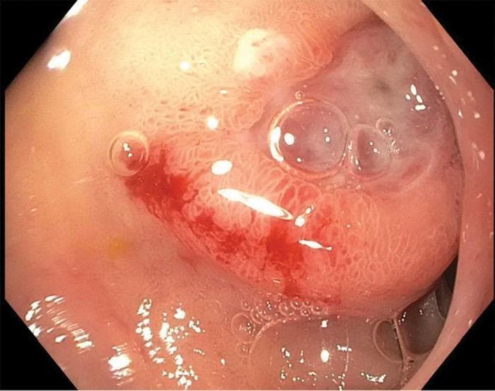 This endoscopic clinical photograph from an upper gastrointestinal endoscopy (EGD) displays the lumen of the distal duodenal bulb. Centered in the frame is a single, approximately 1-cm ulcerated lesion. The ulcer is characterized by a clean base and a slightly protuberant, elevated morphology. Distinctive features include irregular, 'heaped-up' mucosal edges surrounding the ulcer crater, and a cluster of translucent air bubbles typical of the insufflation process. Clinically significant signs of hemorrhage are visible, specifically active oozing of bright red blood (Forrest classification 1B) from the ulcer's margin. The surrounding mucosa shows slight erythema and texture changes indicative of gastric heterotopia or secondary inflammation. This image is an educational example of a peptic ulcer with features suspicious for an underlying mass lesion, requiring differential diagnosis between benign peptic ulcer disease and malignant or stromal tumors such as a Gastrointestinal Stromal Tumor (GIST).