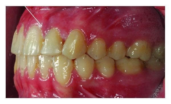 This intraoral clinical photograph provides a left labial view of the permanent maxillary dentition in a 14-year-old female. The primary focus is the maxillary left lateral incisor (tooth 22), which exhibits an abnormal crown morphology characterized by increased mesiodistal width. A vertical developmental groove is visible on the labial surface of the clinical crown, a hallmark feature indicative of dental fusion between the lateral incisor and a supernumerary tooth. The adjacent teeth, including the central incisor and canine, show signs of anterior crowding. The surrounding gingival tissues in the upper left quadrant appear erythematous and glossy with irregular contours, suggesting localized gingival inflammation or gingivitis. This image serves as a clinical example of a rare dental anomaly often associated with conditions like unilateral cleft lip, illustrating the aesthetic and functional challenges that necessitate combined orthodontic and restorative interventions.