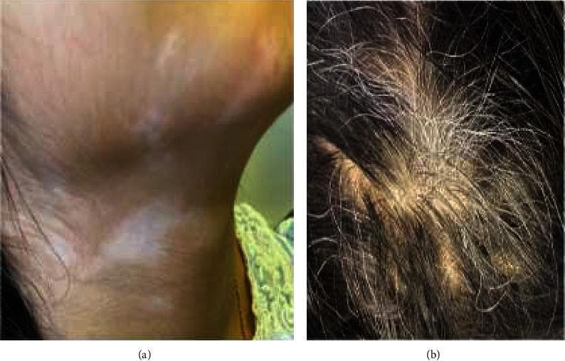 This composite clinical photograph displays dermatological and trichological manifestations of Vogt-Koyanagi-Harada (VKH) syndrome in a pediatric patient. Figure (a) illustrates cutaneous hypopigmentation, consistent with vitiligo, appearing as irregular, milky-white depigmented patches on the neck that contrast with the surrounding normally pigmented skin. Figure (b) shows poliosis (graying of the hair), characterized by a localized patch of depigmented, white/gray hair shafts amidst otherwise dark terminal scalp hair. These findings represent the integumentary phase of VKH syndrome, a multi-system autoimmune disorder targeting melanocytes. Educational focus is on identifying systemic clinical signs—such as vitiligo, poliosis, and alopecia—that occur alongside granulomatous panuveitis in the diagnosis of complete or incomplete VKH syndrome. These visible markers are essential for clinical classification and monitoring treatment response to immunosuppressive therapy.