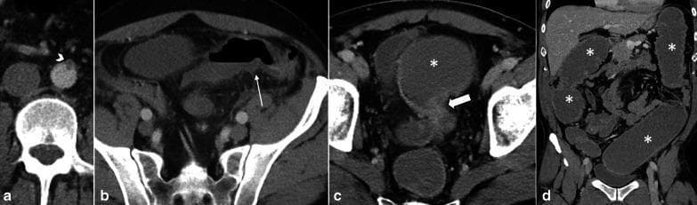 This composite of abdominal CT images illustrates the progression and long-term sequelae of acute mesenteric arterial thrombosis. Panel (a) is an axial contrast-enhanced CT showing complete thrombotic occlusion at the origin of the inferior mesenteric artery (IMA), identified by a non-enhancing filling defect (arrowhead). Panel (b) demonstrates the acute stage of watershed ischemia in the sigmoid colon, characterized by segmental mural thickening and hypoenhancement (thin arrow). Panels (c) and (d) are follow-up axial and coronal CT scans obtained three months later, illustrating the chronic complication of ischemic bowel. A localized fibrotic stricture is visible in the distal sigmoid colon (thick arrow), resulting in high-grade mechanical bowel obstruction. This is evidenced by significant upstream colonic dilatation (asterisks), where the proximal bowel loops are markedly distended with fluid and gas. The series highlights the progression from acute vascular occlusion to intermediate-stage tissue ischemia and, finally, to late-stage fibrotic luminal narrowing and secondary obstruction.