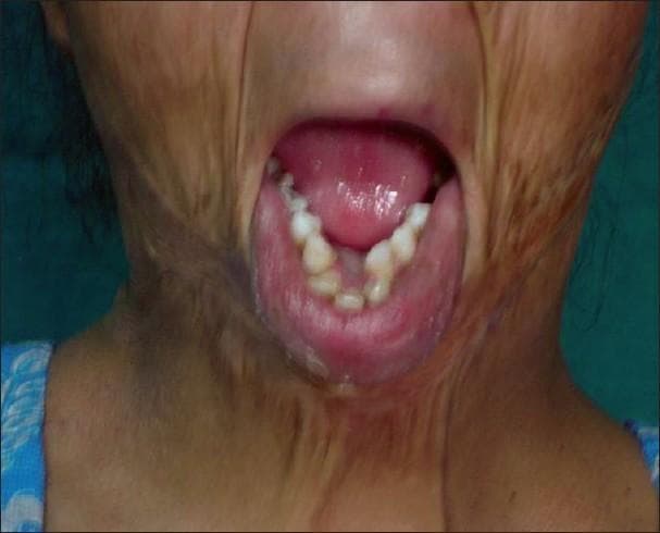 This clinical photograph displays a frontal view of a patient’s face and neck, illustrating the long-term sequelae of severe burn injuries. The image captures extensive, diffuse post-burn scarring across the lower face and neck, characterized by a mixture of hypopigmented and hyperpigmented areas and irregular, hypertrophic texture. A significant vertical scar contracture is visible on the neck, which is actively pulling down the mandible. This mechanical tension has resulted in a marked mandibular deformity and secondary dental malocclusion. The patient's mouth is open, revealing an asymmetrical, V-shaped dental arch in the lower jaw where the teeth are misaligned and tilted anteriorly due to the chronic traction from the neck contracture. The image serves as a clinical example of how unreleased soft tissue contractures can lead to permanent skeletal and occlusal changes, necessitating combined plastic surgical release and orthodontic or orthognathic intervention.