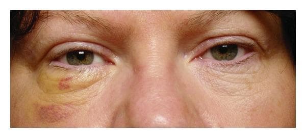 This clinical photograph shows a close-up, frontal view of a 49-year-old female's mid-face, specifically the periorbital region, six days post-orbital surgery. The primary clinical focus is on the postoperative appearance of the left eye compared to the normal right eye. The left infraorbital and periorbital area exhibits significant ecchymosis and edema. A prominent yellowish-green hue (indicative of resolving bilirubin) is visible across the lower eyelid, extending toward the lateral canthus. Within this yellow region, there is a localized reddish-purple area. Inferior to this, on the malar eminence, a larger purplish-red ecchymotic patch suggests deeper tissue involvement or recent hematoma resolution. The left lower eyelid also demonstrates increased skin wrinkling and mild drooping (ectropion or pseudoptosis due to swelling) compared to the contralateral side. The right eye appears healthy with normal skin texture and no discoloration. This image serves as an educational tool for monitoring normal postoperative healing stages, tissue trauma recovery, and the typical color progression of bruising following ophthalmologic or orbital tumor surgery.
