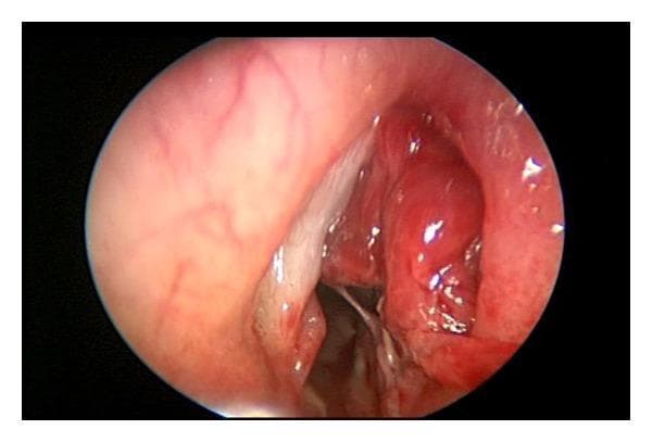 This endoscopic clinical photograph displays the laryngeal inlet during suspension laryngoscopy, specifically showing a right-sided laryngopyocele. The image reveals a prominent, bulging, erythematous mass protruding from the supraglottic area, causing partial obstruction of the airway lumen. The surface of the mass is smooth yet irregular in contour, with areas of intense hyperemic redness and lighter highlights suggestive of moist mucosal secretions. Adjacent to the mass, a white fibrous-appearing vocal cord is visible, though it is displaced by the swelling. The surrounding laryngeal mucosa appears edematous and inflamed with visible vascular markings. This image illustrates the typical clinical presentation of an infected laryngocele (laryngopyocele) requiring surgical intervention such as marsupialization or de-roofing to secure the airway and drain purulent material.