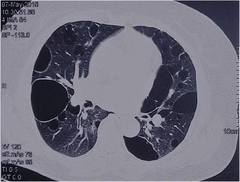 This diagnostic axial chest CT scan demonstrates a primary pathology of diffuse cystic lung disease. Multiple thin-walled air-filled cysts are distributed bilaterally throughout the lung parenchyma. The cysts vary significantly in size, with several large, dominant cysts measuring several centimeters in diameter located predominantly in the subpleural and peripheral regions. The cysts exhibit a lenticular or irregular morphology with well-defined, paper-thin walls. The intervening lung parenchyma and tissue immediately surrounding the cysts appear relatively normal in density, without evidence of ground-glass opacities, consolidation, or significant interstitial fibrosis. The vascular and bronchial structures are anatomically visible but displaced by the cystic lesions. These findings are characteristic of Birt-Hogg-Dubé (BHD) syndrome, a genetic condition often presenting with multiple basally located pulmonary cysts. The image serves as a clinical example for differentiating cystic lung diseases such as lymphangioleiomyomatosis (LAM) or pulmonary Langerhans cell histiocytosis (PLCH).