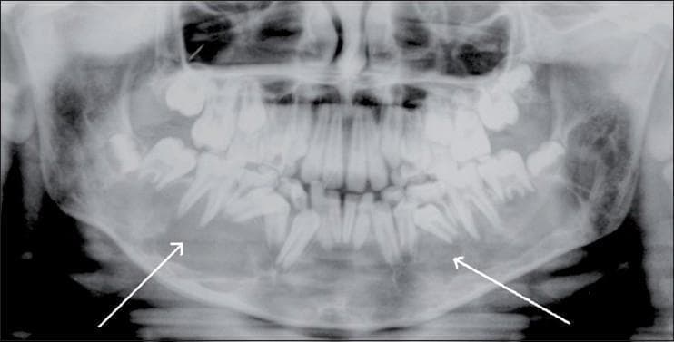 This orthopantomogram (panoramic dental X-ray) of a pediatric patient displays a large, bilateral expansile osteolytic lesion within the body of the mandible. The pathology is characterized by a significant area of radiolucency extending across the midline, involving both the right and left mandibular bodies. The lesion features well-defined, sclerotic margins, indicating a slow-growing process. Its expansile nature is evidenced by the thinning and outward bowing of the mandibular cortex. Notably, the lesion causes displacement of developing permanent teeth and molar roots, which is a common finding in intraosseous vascular malformations (AVMs) or giant cell lesions. Two white arrows highlight the lateral extents of the radiolucent area. This diagnostic image is used to illustrate primary dental/maxillofacial radiology findings for osteolytic jaw lesions and is essential for the differential diagnosis of mandibular bone expansion in young patients.