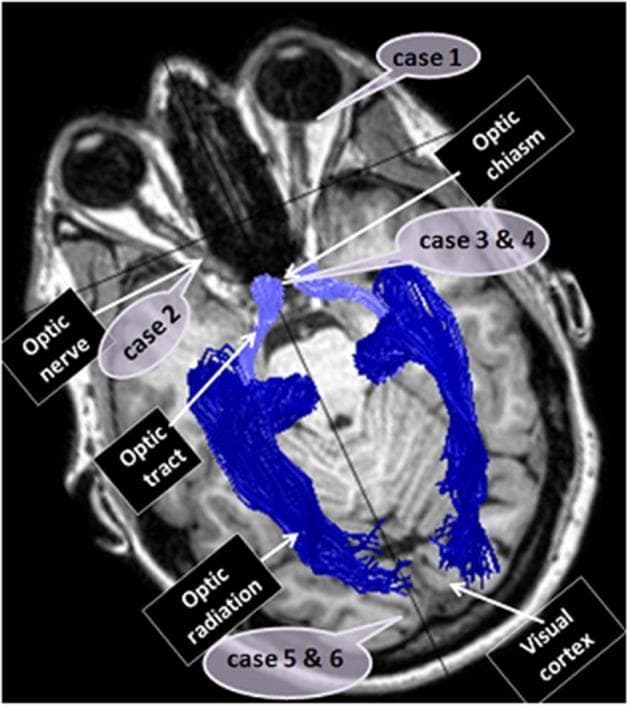 This diagnostic image features an axial T1-weighted Magnetic Resonance Imaging (MRI) scan of the human brain, integrated with blue Diffusion Tensor Imaging (DTI) fiber tractography to visualize the visual pathway. The illustration maps the neuroanatomical trajectory from the orbits to the occipital lobe. Key structures are labeled: the optic nerve (extending from the posterior eye), the optic chiasm (central decussation), the optic tract (posterior to the chiasm), and the optic radiation (projecting to the visual cortex). Additionally, the image serves as a clinical localization map for six case reports, identifying specific sites of dysfunction: Case 1 (eye), Case 2 (optic nerve), Cases 3 and 4 (optic chiasm), and Cases 5 and 6 (visual cortex). This combination of structural MRI and DTI tractography demonstrates the spatial relationship between clinical pathology and white matter pathways, supporting advanced neuro-ophthalmological education and radiological diagnosis.