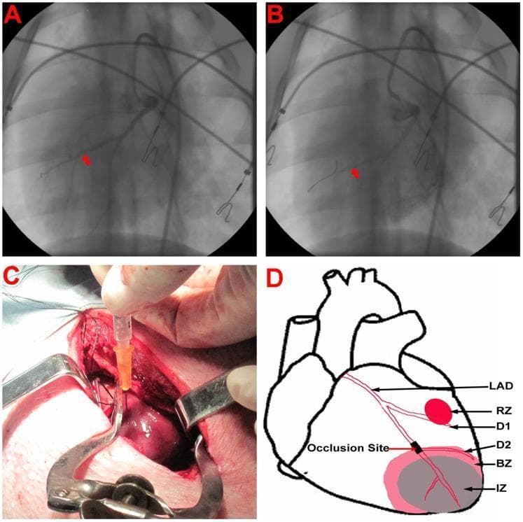 This composite image illustrates the creation and treatment of an acute myocardial infarction (AMI) model. Panel A and B are fluoroscopic angiograms showing the left anterior descending (LAD) artery before (A) and during (B) balloon catheter occlusion, indicated by red arrows. Panel C is a clinical photograph of an open-heart surgical procedure where a hypodermic needle is used for direct intramyocardial injection into the exposed heart surface. Surgical retractors and sutures are visible within the thoracic cavity. Panel D is a schematic anatomical diagram of the heart depicting the coronary anatomy and post-infarct zones. It labels the LAD, its diagonal branches (D1, D2), and the distal occlusion site. The diagram highlights the three functional territories: the Infarct Zone (IZ, grey), the Border Zone (BZ, light pink), and the Remote Zone (RZ, red dot). This visual set demonstrates the methodology for translational cardiology research, specifically modeling ischemic injury and subsequent therapeutic cell delivery.