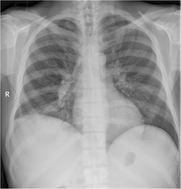 This diagnostic image is a posterior-anterior (PA) chest radiograph illustrating diffuse osteosclerosis secondary to primary myelofibrosis. The primary visual finding is a generalized, symmetrical increase in radiographic density (bone whitening) across all visible skeletal elements, including the ribs, clavicles, and vertebral bodies. This sclerotic change is characterized by a loss of the normal trabecular pattern and a markedly opaque appearance of the bone compared to surrounding soft tissues. Despite the axial skeleton involvement, the lung parenchyma remains relatively clear with preserved vascular markings and no evidence of consolidation, pulmonary edema, or pleural effusion. The cardiac and mediastinal contours are within normal limits, and the hila are not enlarged. This presentation is a classic imaging hallmark of myeloproliferative neoplasms (MPN), where bone marrow fibrosis leads to increased bone formation. It serves as a key educational example of how systemic hematologic disorders can manifest incidentally as metabolic bone disease on routine imaging.