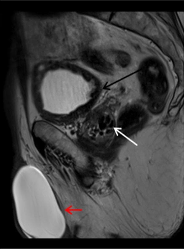 A sagittal T2-weighted MRI of the male pelvis and scrotum demonstrating several urogenital pathologies. In the right scrotum, a large, well-circumscribed, oval lesion (marked with a red arrow) shows homogeneous high T2 signal intensity, characteristic of a hydrocele. The lesion is located within the tunica vaginalis, causing significant scrotal distension. The urinary bladder exhibits a thickened wall with low T2 signal intensity (marked with a black arrow) and an irregular, trabeculated appearance, suggesting chronic bladder outlet obstruction or chronic cystitis; internal layering debris is also noted within the bladder lumen. Within the prostate gland, multiple small, well-defined, low T2 signal intensity foci are visible (marked with a white arrow), representing prostatic calcifications. This image is used for educational purposes to distinguish normal pelvic anatomy from common urological findings such as hydrocele, bladder wall trabeculation, and prostatic lithiasis.