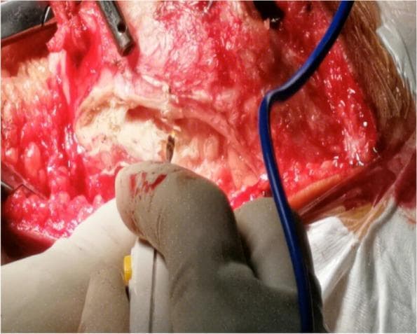 This clinical photograph captures an intraoperative view of an open orthopedic surgical procedure on the knee joint, specifically demonstrating a lateral soft tissue release for the treatment of habitual patellar dislocation. The surgical field shows a deep midline incision with significant exposure of the underlying musculoskeletal structures. The patella and patellar tendon are visible, surrounded by dissected soft tissues including vastus muscle fibers and connective fascia. Evidence of active surgical manipulation is present through the visible bone surfaces and blood-tinged tissues. A gloved hand is shown in the foreground holding an electrosurgical unit (bovie) to maintain hemostasis or perform further dissection. Additional metallic surgical instruments and a blue suction or monitoring tube are positioned within the operative site. This image serves as a high-level educational example of the complex soft tissue releases required to achieve anatomical patellar reduction in adolescent patients.