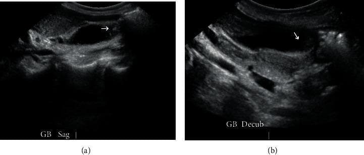 Diagnostic ultrasound images of the gallbladder in two planes: (a) sagittal view and (b) decubitus view. Both images reveal cholelithiasis, characterized by the presence of hyperechoic (bright) foci within the anechoic (fluid-filled) lumen of the gallbladder. White arrows in both frames highlight specific gallstones. The gallbladder wall appears thin and without significant distension, indicating cholelithiasis without acute cholecystitis. The liver parenchyma is visible adjacent to the gallbladder as a medium-echogenicity structure. These views are utilized in clinical practice to confirm the presence and mobility of stones, as the decubitus position helps redistribute luminal contents to differentiate mobile stones from stationary polyps. The image serves as an educational example of biliary imaging in the context of suspected gallstone pancreatitis or symptomatic cholelithiasis.
