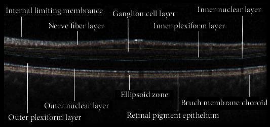 This diagnostic image is an Optical Coherence Tomography (OCT) cross-section of the human retina, illustrating a high-resolution view of the interretinal layers. The image features comprehensive labeling of the retinal anatomy from the inner to the outer layers. Key structures identified include the Internal Limiting Membrane (ILM), Nerve Fiber Layer (NFL), Ganglion Cell Layer (GCL), Inner Plexiform Layer (IPL), and Inner Nuclear Layer (INL) in the inner retina. The outer retinal structures are clearly delineated, including the Outer Plexiform Layer (OPL), Outer Nuclear Layer (ONL), Ellipsoid Zone (EZ), Retinal Pigment Epithelium (RPE), and the Bruch Membrane Choroid complex. The EZ and RPE appear as distinct hyperreflective (bright) bands, while layers like the ONL appear hyporeflective (dark). This clinical imaging modality is essential in ophthalmology for diagnosing and monitoring conditions such as Multiple Sclerosis (MS)-related optic neuritis, macular degeneration, and diabetic retinopathy by assessing layer thickness and integrity.