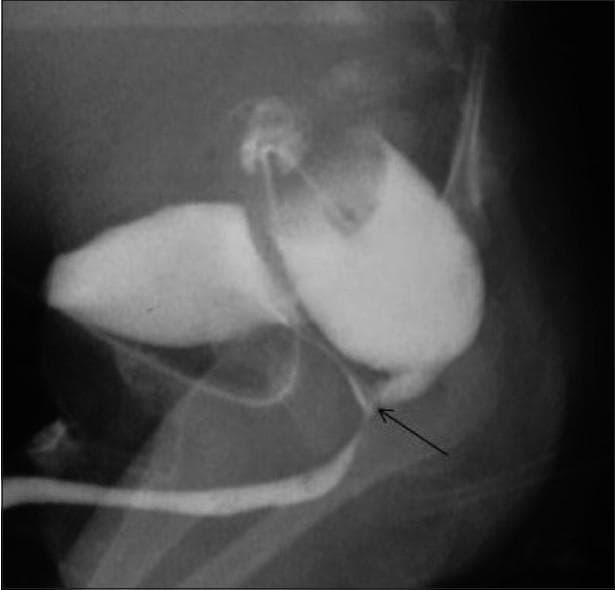 This diagnostic X-ray image is a lateral contrast cologram of a pediatric male patient, illustrating high-type anorectal malformation. The study reveals anorectal agenesis, characterized by a blind-ending distal rectum that fails to reach the perineum. A clear fistulous communication (rectourethral fistula) is demonstrated, where contrast medium flows from the distal rectum into the bulbar segment of the urethra, indicated by a black arrow. The radiograph shows simultaneous opacification of the rectal pouch, the fistulous tract, and the lower urinary tract, including the urethra. This finding is clinically significant for surgical planning in cases of imperforate anus where meconium may be observed in the urine. The image serves as an educational example of congenital urogenital and gastrointestinal anomalies, specifically highlighting the anatomical relationship between the rectum and the bulbar urethra in intermediate to high-level anorectal malformations.