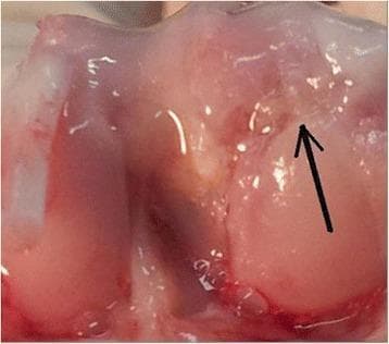 This clinical photograph shows a macroscopic view of an articular joint surface, specifically focusing on a focal cartilage defect undergoing repair. The image highlights a specific lesion (indicated by a black arrow) characterized by significant surface irregularities. The repairing tissue within the defect exhibits a distinct purple-whitish color and a textured, uneven morphology compared to the smooth, glistening appearance of the surrounding healthy hyaline cartilage. This visual illustrates the outcome of a microfracture (mfx) surgical procedure, demonstrating the formation of fibrocartilage-like repair tissue which often lacks the structural regularity and integration seen in higher-quality hyaline-like repair. The image serves as a clinical reference for orthopedic evaluation of cartilage regeneration, specifically showcasing the characteristic irregular surface of early or suboptimal healing in a microfracture-only treatment group.