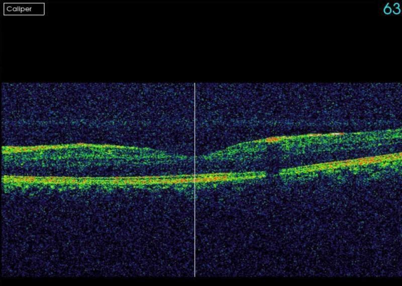 This diagnostic image is an Optical Coherence Tomography (OCT) cross-sectional scan of the human retina, specifically of the macula in the left eye. The scan demonstrates normal retinal architecture with clearly defined, continuous anatomical layers. Key visible features include a distinct, hyperreflective band representing the inner limiting membrane (ILM) and a parallel, highly hyperreflective layer corresponding to the retinal pigment epithelium (RPE) and Bruch's membrane complex. Between these layers, the neurosensory retinal layers exhibit expected variations in reflectivity and thickness. There is no evidence of intraretinal edema, subretinal fluid, retinal thickening, or structural disruptions such as drusen or membrane detachments. The foveal contour appears unremarkable, confirming a normal physiological state in this clinical view. This image serves as a reference for healthy retinal morphology in ophthalmology and optometry education.