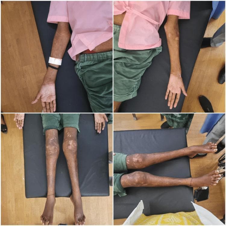 This four-panel clinical photograph illustrates multisystemic manifestations of a metabolic bone disease, likely rickets or osteomalacia, in a young patient. The top panels show the upper extremities, highlighting bilateral widening and enlargement of the elbow and wrist joints, which are hallmark signs of metaphyseal expansion. The bottom panels display the lower extremities in supine and lateral views, demonstrating significant genu valgum (knock-knee deformity) and flexion contractures at the knees. Accompanying these musculoskeletal findings are dermatological lesions characterized by diffuse, mottled hypopigmented and depigmented patches distributed symmetrically across the arms, legs, and periarticular regions. The patient exhibits an ectomorphic build with noticeable muscle wasting. These combined features serve as educational indicators for systemic conditions involving calcium/phosphorus dysregulation and chronic skin involvement, emphasizing the clinical presentation of vitamin D deficiency or similar metabolic disorders in an adolescent or young adult.