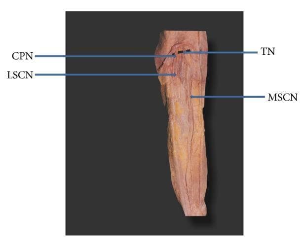 This clinical photograph displays a gross anatomical dissection of the posterior lower limb, specifically focusing on the nerves of the popliteal fossa and the proximal leg. The image illustrates a specific anatomical variation where the medial sural cutaneous nerve (MSCN) continues distally as the sural nerve without joining a peroneal communicating branch. Key labeled structures include the tibial nerve (TN) and common peroneal nerve (CPN) branching proximally. Arising from the CPN is the lateral sural cutaneous nerve (LSCN), which descends toward the lateral aspect of the gastrocnemius. The MSCN is shown originating from the tibial nerve and coursing vertically down the midline of the posterior leg superficial to the gastrocnemius muscle. This specimen serves as an educational example of peripheral nerve anatomy and sural nerve formation patterns, which is clinically significant for nerve conduction studies, sural nerve biopsies, and regional anesthesia blocks.