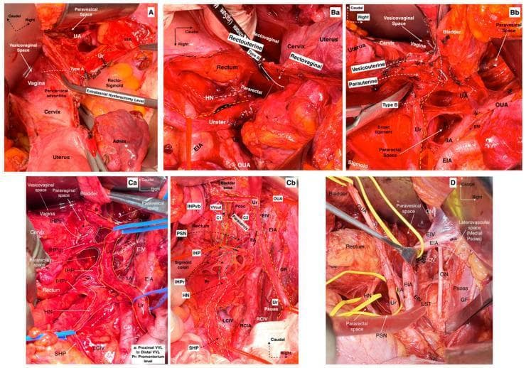 A multi-panel series of intraoperative clinical photographs illustrating surgical anatomy and resection planes for different types of Radical Hysterectomy (RH) according to the Querleu-Morrow classification. Panel A shows Type A minimal RH with a resection level between the pericervical adventitia and the ureter (Ur). Panels Ba and Bb demonstrate Type B modified RH, highlighting resection along the longitudinal axis of the ureter involving the parauterine and vesicouterine ligaments. Panels Ca and Cb depict Type C1 nerve-sparing RH, focusing on the preservation of the inferior hypogastric plexus (IHP) vesical branches and resection of the proximal vesicovaginal ligament (VVL). Panel D illustrates the anatomy for paracervical lymphadenectomy, showing the laterovascular plane (medial psoas plane) bounded by the obturator nerve (ON), external/internal iliac vessels (EIA/EIV/IIA), and the lumbosacral trunk (LST). Key anatomical landmarks identified across the panels include the uterine artery (UA), hypogastric nerves (HN), pelvic splanchnic nerves (PSN), and various pelvic avascular spaces (paravesical, pararectal, and vesicovaginal).