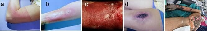 This clinical series demonstrates the progression of burn severity categorized by depth and tissue involvement. (a) First-degree burn (superficial): Presents as erythema of the epidermis without blistering, consistent with a sunburn. (b) Second-degree superficial partial-thickness burn (SPTB): Displays clear blistering (bullae) and moist, red tissue, indicating damage to the papillary dermis. (c) Second-degree deep partial-thickness burn (DPTB): Shows a mottled appearance with ruptured blisters and more significant exudate, extending into the reticular dermis. (d) Third-degree burn (full-thickness): Characterized by a central area of leathery, dark eschar formation surrounded by a zone of stasis, indicating total destruction of the epidermis and dermis into the subcutaneous fat. (e) Fourth-degree burn: Illustrates the most severe injury, extending through all skin layers to involve underlying fascia, skeletal muscle (rectus abdominis), and potentially bone, appearing charred and necrotic. This visual comparison serves as an educational tool for clinical triage and the classification of thermal injuries.
