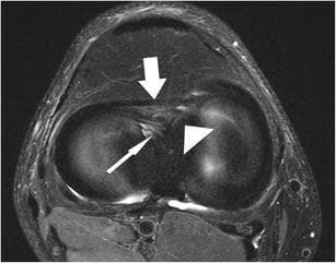 This diagnostic image is an axial proton-density-weighted, fat-suppressed fast spin echo (FSE) MRI of a human knee joint. The imaging modality highlights musculoskeletal structures by suppressing high-signal fat, allowing for detailed visualization of ligaments and meniscal attachments. The image demonstrates three key anatomical features: the anterior intermeniscal (transverse) ligament, indicated by a thick white arrow, which appears as a hypointense band connecting the anterior horns of the menisci; the anterior root of the medial meniscus, marked by a thin white arrow; and the anterior root of the lateral meniscus, indicated by a white arrowhead. These structures exhibit characteristic low signal intensity against the intermediate signal of surrounding tissues. The scan illustrates normal meniscal anatomy and root insertions, which are critical for maintaining meniscal stability and load distribution within the knee. This high-resolution axial section is essential for identifying meniscal root tears or variations in the intermeniscal ligament that could be misinterpreted as pathology in other planes.