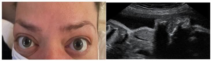This dual-panel image demonstrates maternal and fetal manifestations of Graves' disease. The left panel is a clinical photograph of a pregnant woman's face, showing classic signs of thyroid-associated orbitopathy (TAO). Key features include bilateral exophthalmos (proptosis), lid retraction with visible superior scleral show, and periorbital edema, indicative of active Graves' ophthalmopathy. The right panel displays an obstetric ultrasound image focusing on the fetal neck. The ultrasound reveals a significant hyperechoic mass in the anterior cervical region, consistent with a fetal goiter. This finding in the context of maternal Graves' disease suggests fetal thyroid dysfunction caused by the transplacental passage of maternal thyroid-stimulating hormone receptor antibodies (TRAb). The image serves as a clinical illustration of the correlation between maternal autoimmune thyroid activity and potential neonatal hyperthyroidism or goitrous development during pregnancy.