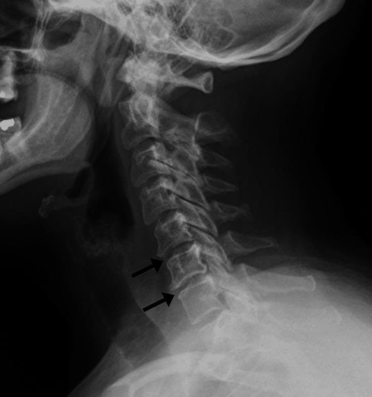 This lateral view diagnostic radiograph (X-ray) of the cervical spine demonstrates skeletal anatomy from the base of the skull to the upper thoracic region. The image reveals early-stage degenerative changes, specifically cervical spondylosis, localized to the mid-to-lower cervical levels. Key findings include a visible reduction in intervertebral disc height at the C5-C6 and C6-C7 levels. Black arrows highlight the presence of marginal anterior osteophyte formation (bony spurs) projecting from the anterior aspect of the C5 and C6 vertebral bodies. While the overall vertebral alignment and the spinal curvature appear maintained, the disc space narrowing and bone remodeling indicate chronic degenerative joint disease. The posterior elements, including the spinous processes and laminae, are visible without overt fracture or displacement. This image serves as a typical clinical example of age-related or post-traumatic spondylotic changes that can lead to symptoms like neck pain or radiculopathy through foraminal encroachment.